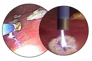 APC (Argon Plasma Coagulation)