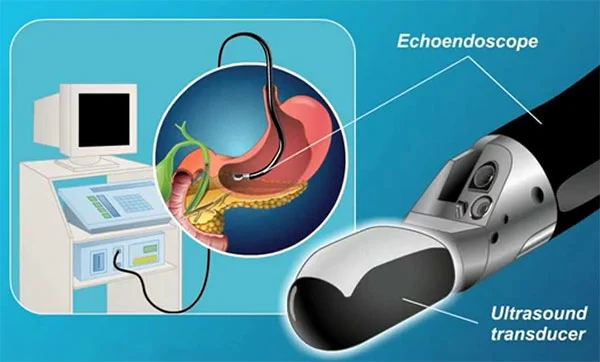 Endoscopic Ultrasound(EUS) 